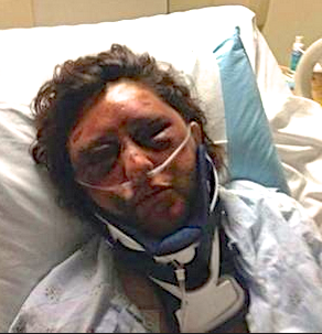 Kelly Papleo suffered broken bones and underwent brain surgery following an attack inside her apartment in April.